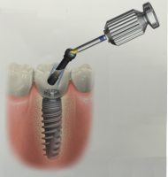 NobelProcera Implants